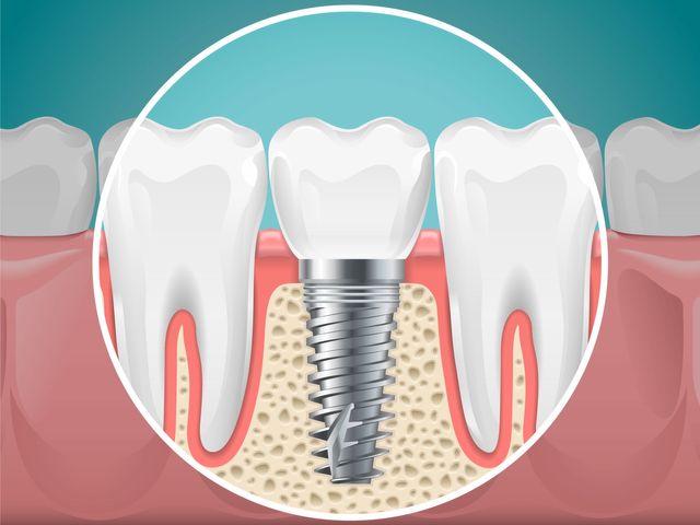 Dental Implants