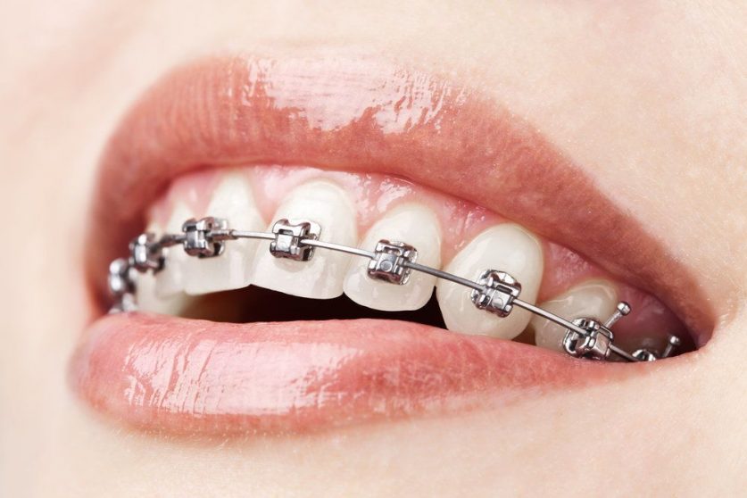 power chains braces