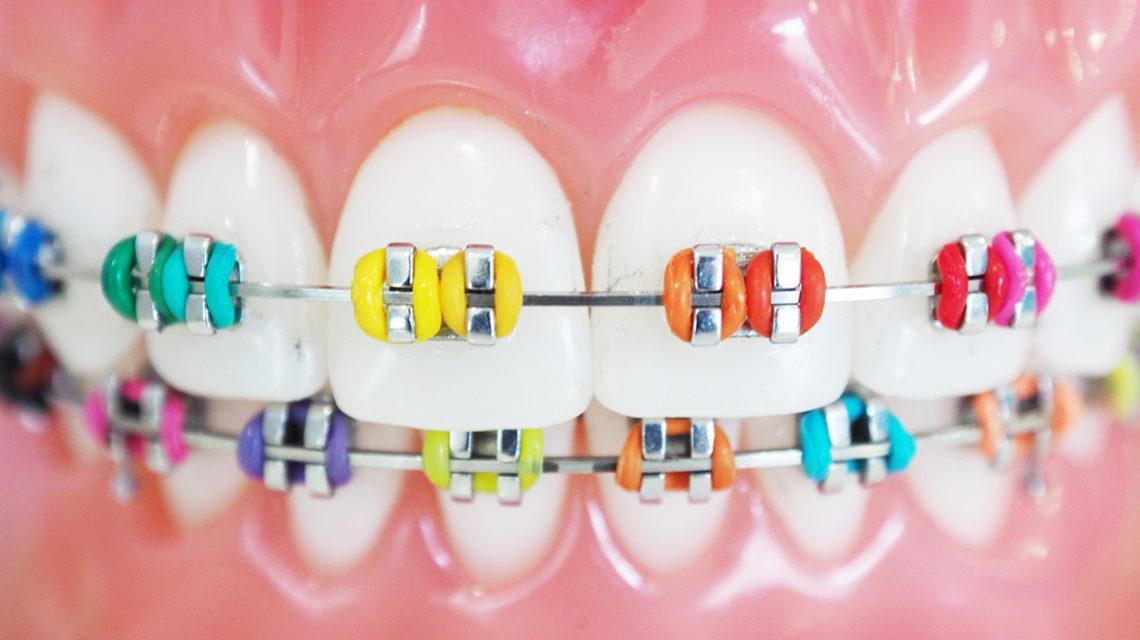 Braces Colors