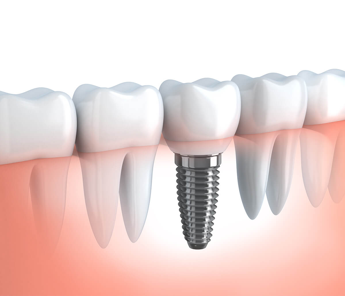 Dental Implants Dentist