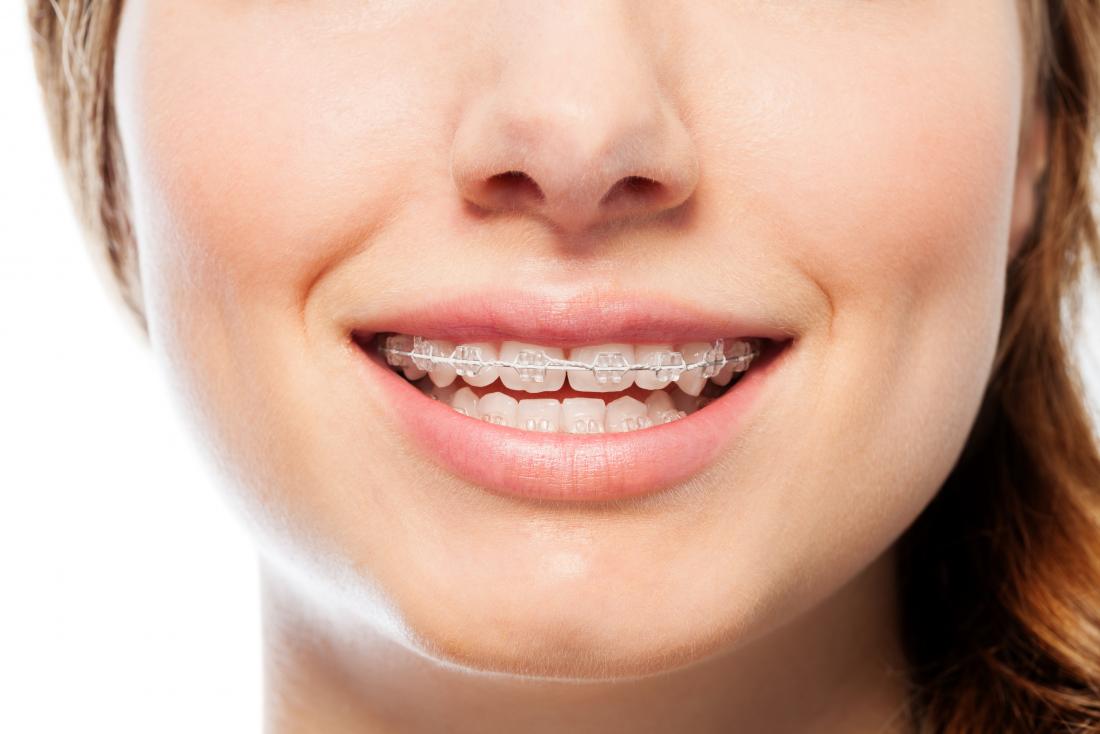 Orthodontic Treatments