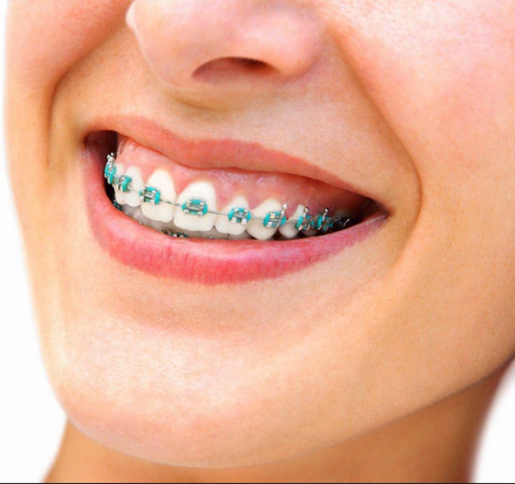 Affordable Braces Near Me Miami Orthodontist Specialist affordable-braces-near-me-miami-orthodontist-specialist
