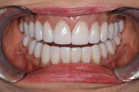 porcelain veneers near me in Houston TX